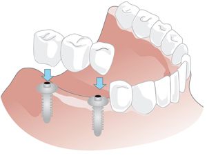 Implantatgetragene Brücke in einer Freiendsituation